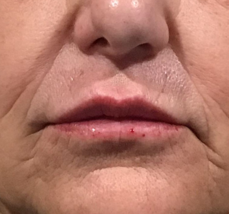 Lip Injections Case 34 After Image