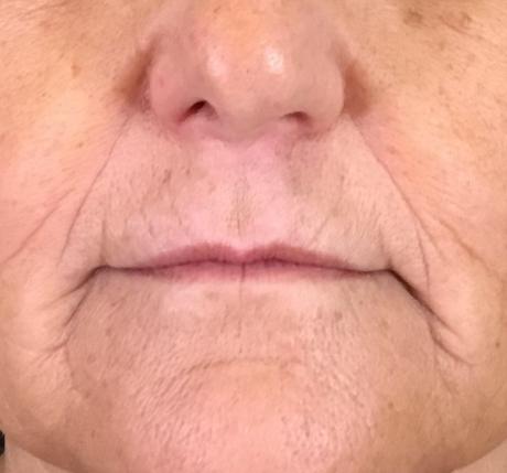 Lip Injections Case 34 Before Image