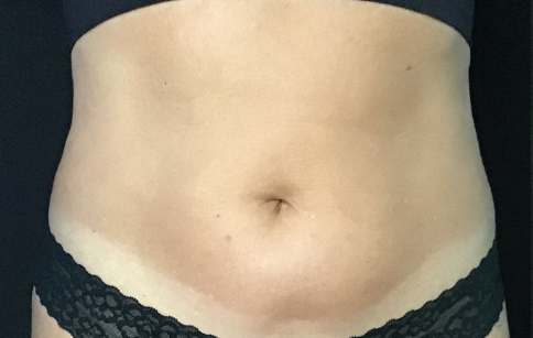 Coolsculpting® ELITE Case 39 Before Image
