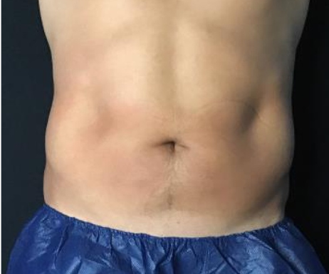 Coolsculpting® ELITE Case 40 After Image