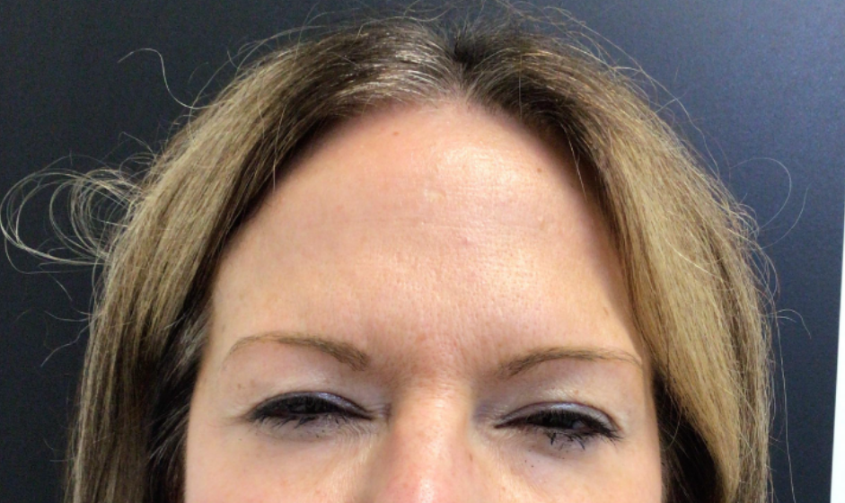 Botox® / Dysport® Case 56 After Image
