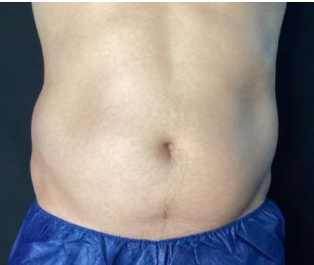 Coolsculpting® ELITE Case 40 Before Image