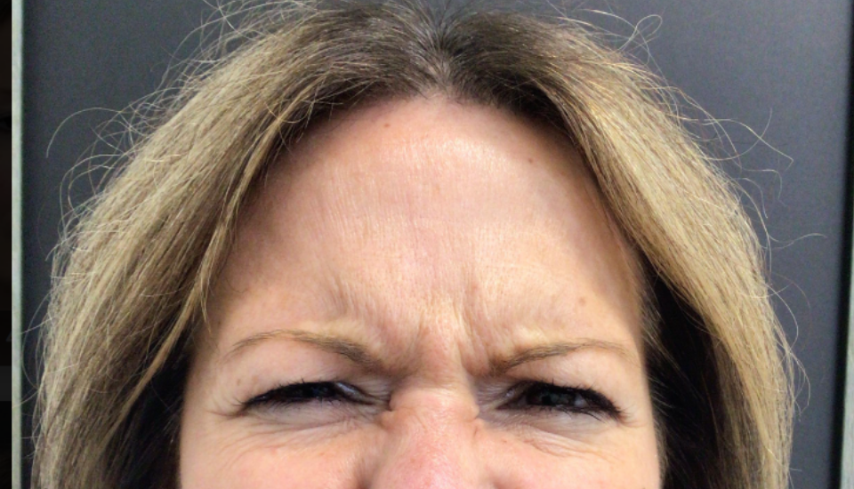 Botox® / Dysport® Case 56 Before Image