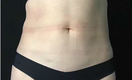 Coolsculpting® ELITE Case 41 After Image