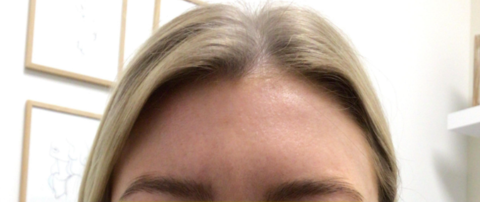 Botox® / Dysport® Case 34 After Image