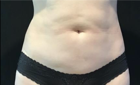 Coolsculpting® ELITE Case 41 Before Image