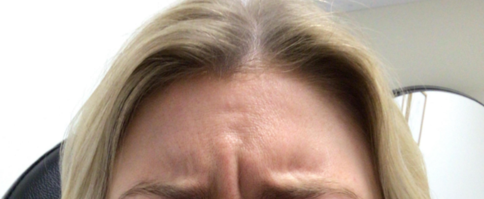 Botox® / Dysport® Case 34 Before Image