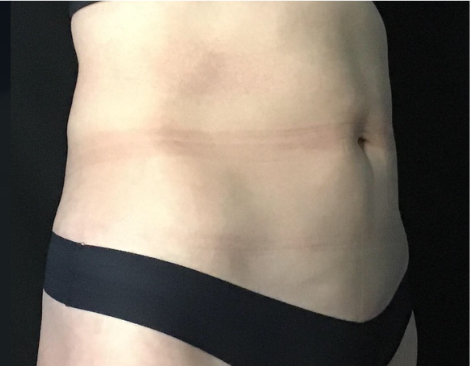 Coolsculpting® ELITE Case 42 After Image