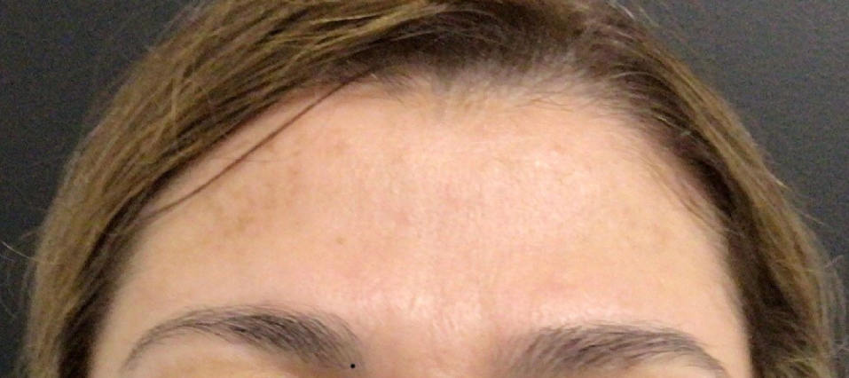 Botox® / Dysport® Case 35 After Image