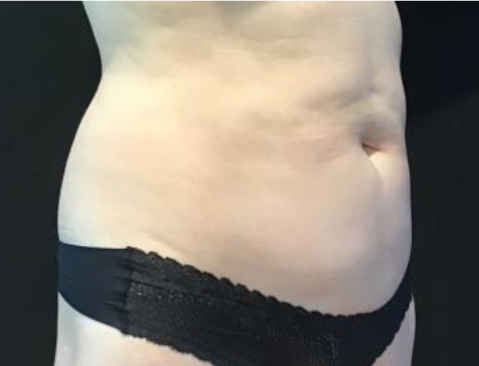 Coolsculpting® ELITE Case 42 Before Image