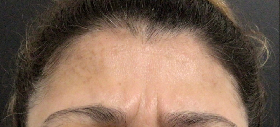 Botox® / Dysport® Case 35 Before Image