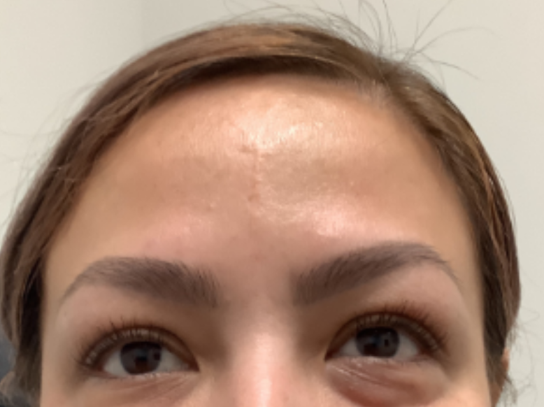 Botox® / Dysport® Case 40 After Image
