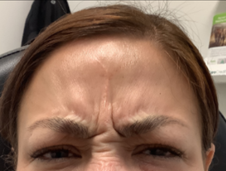 Botox® / Dysport® Case 40 Before Image