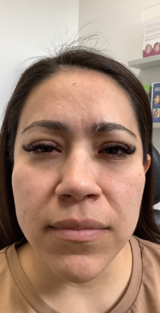 Botox® / Dysport® Case 37 After Image