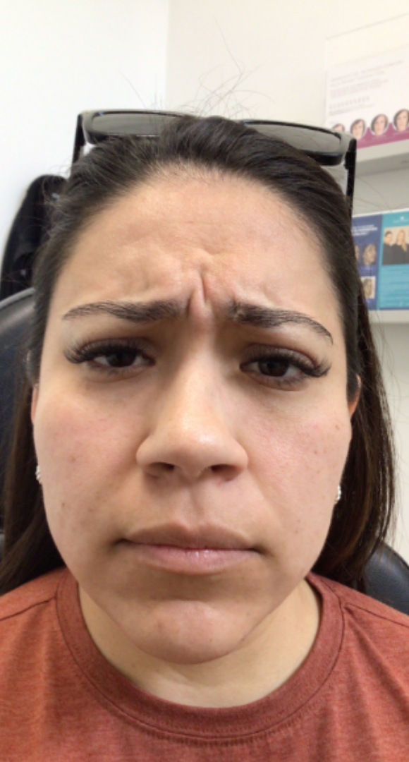 Botox® / Dysport® Case 37 Before Image