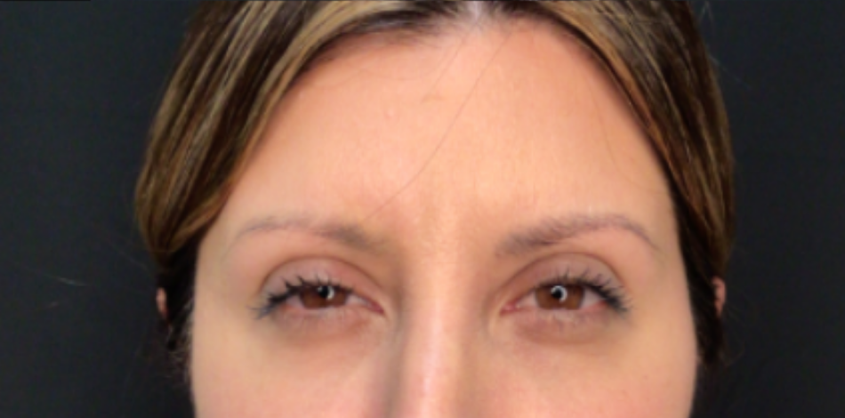 Botox® / Dysport® Case 41 After Image