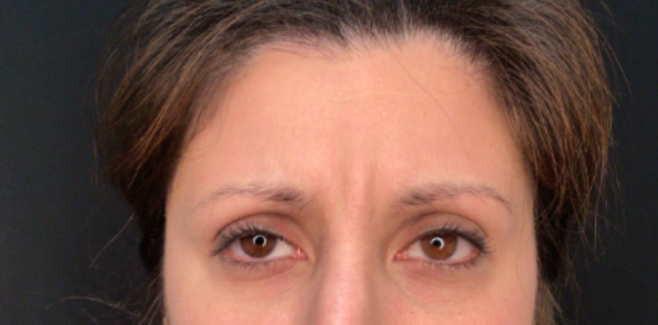 Botox® / Dysport® Case 41 Before Image