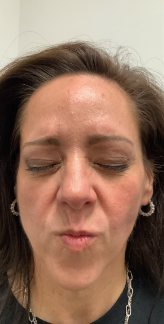 Botox® / Dysport® Case 42 After Image