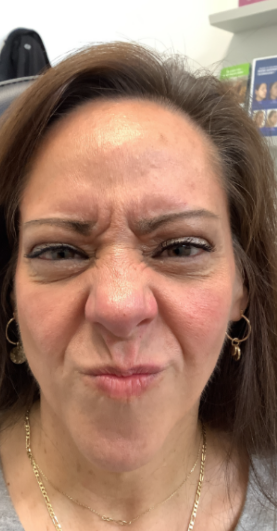 Botox® / Dysport® Case 42 Before Image