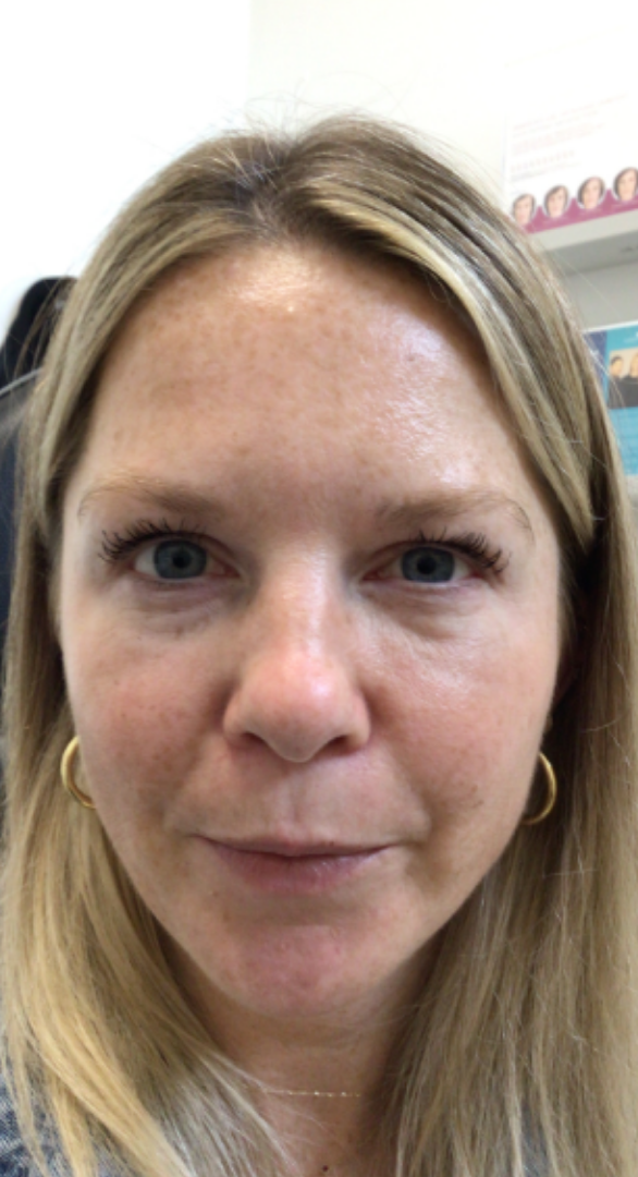 Botox® / Dysport® Case 43 After Image