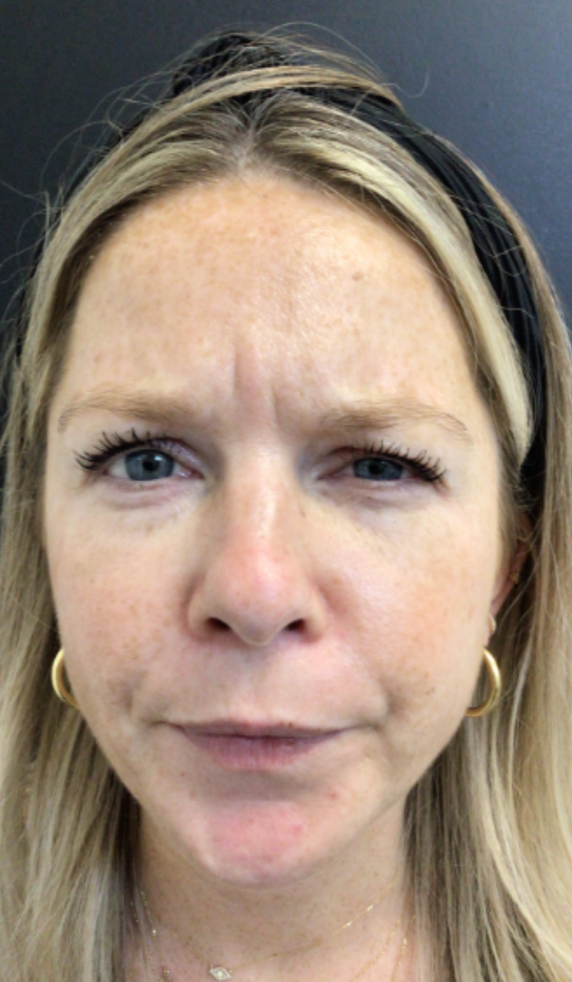 Botox® / Dysport® Case 43 Before Image