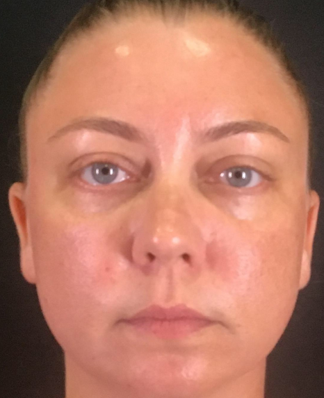 Dermal Fillers Case 50 After Image