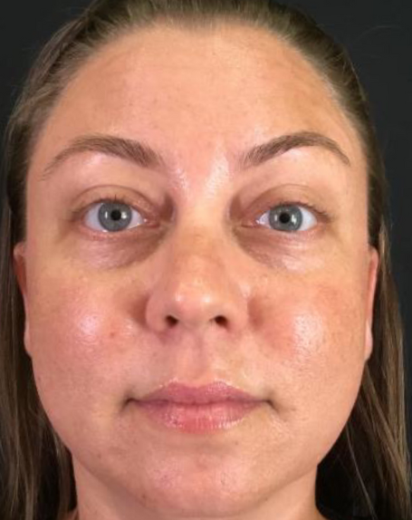 Dermal Fillers Case 50 Before Image