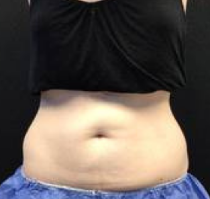 Coolsculpting® ELITE Case 53 After Image
