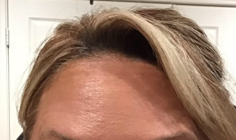 Botox® / Dysport® Case 21 After Image
