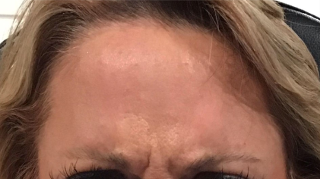 Botox® / Dysport® Case 21 Before Image