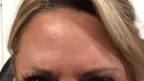 Botox® / Dysport® Case 21 After Image