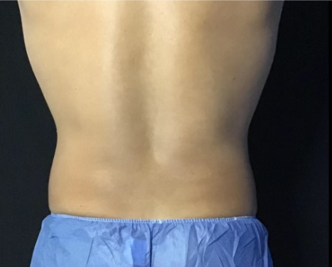 Coolsculpting® ELITE Case 47 After Image