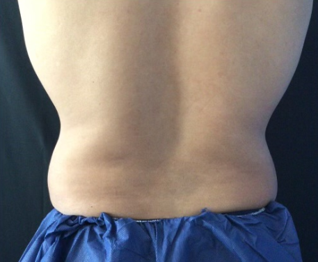 Coolsculpting® ELITE Case 47 Before Image