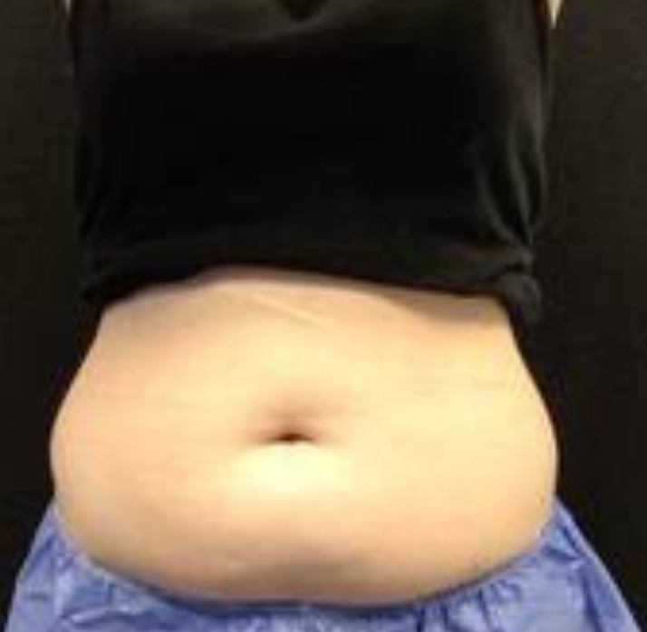 Coolsculpting® ELITE Case 53 Before Image