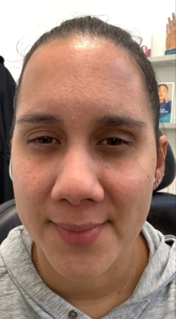 Botox® / Dysport® Case 28 After Image
