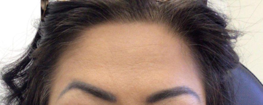 Botox® / Dysport® Case 30 After Image