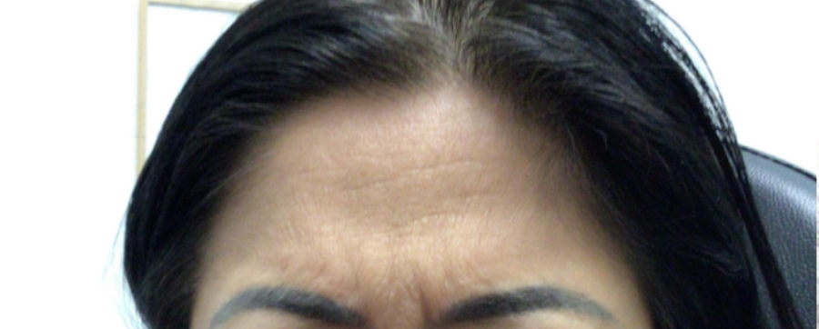Botox® / Dysport® Case 30 Before Image