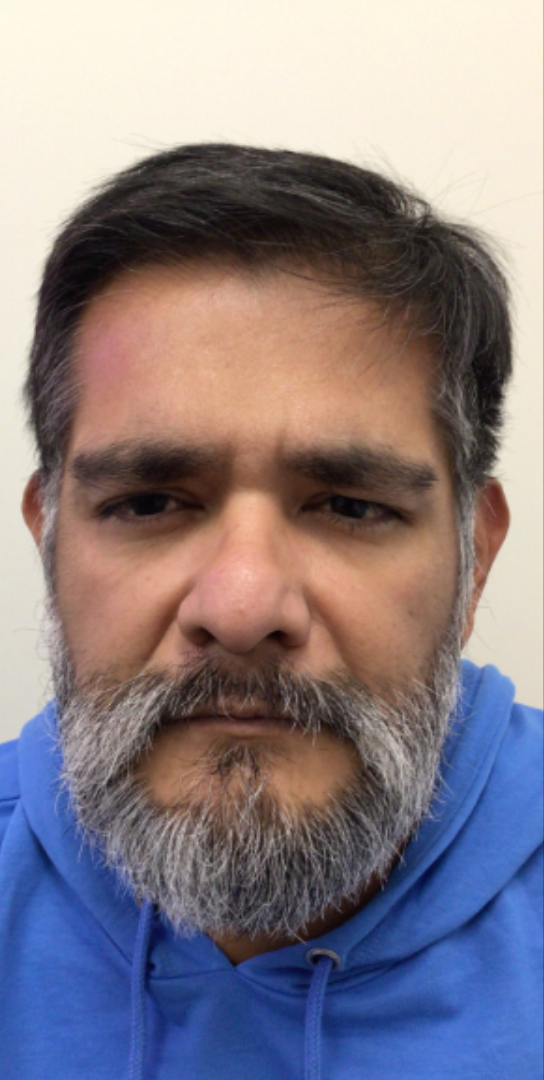 Botox® / Dysport® Case 31 After Image
