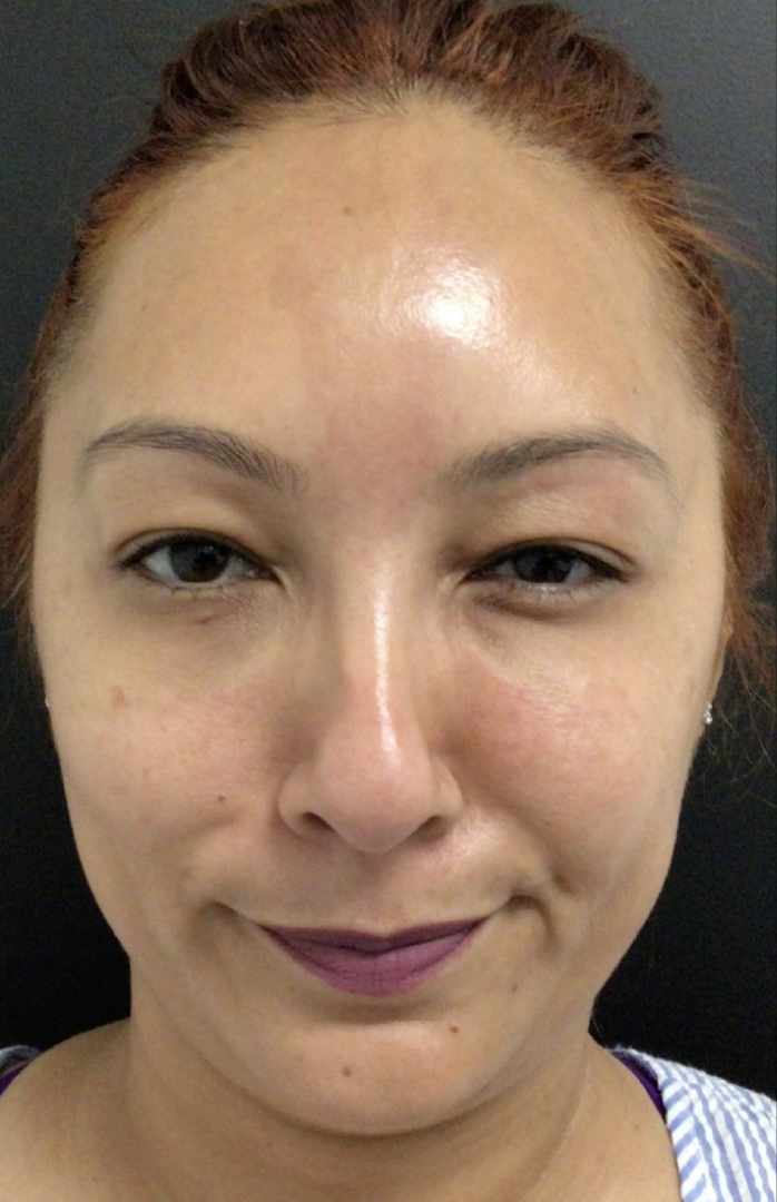 Botox® / Dysport® Case 32 After Image
