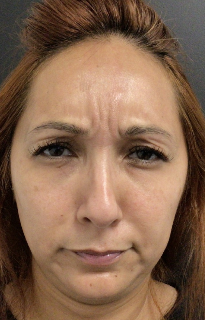 Botox® / Dysport® Case 32 Before Image