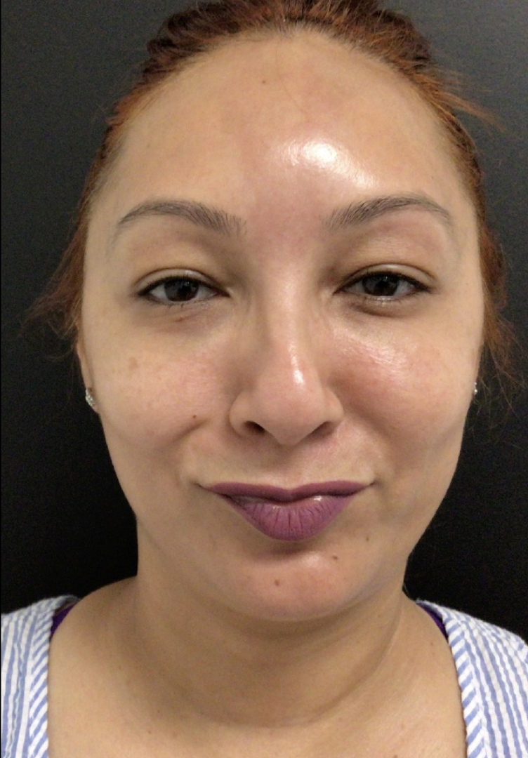 Botox® / Dysport® Case 32 After Image