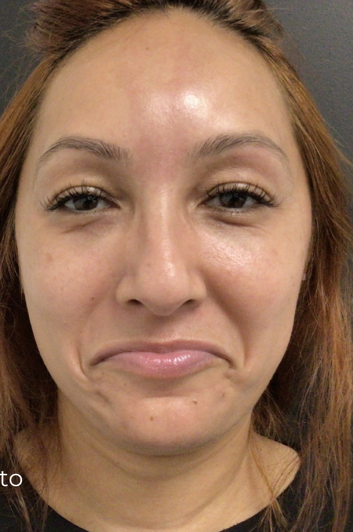 Botox® / Dysport® Case 32 Before Image