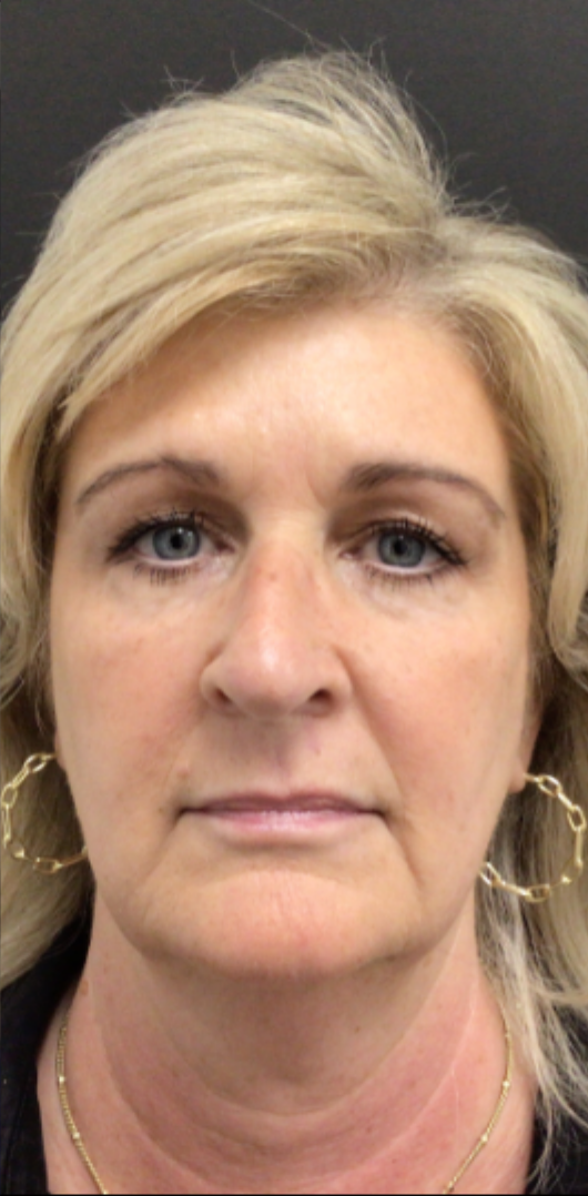Botox® / Dysport® Case 44 After Image
