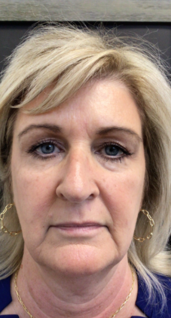 Botox® / Dysport® Case 44 Before Image