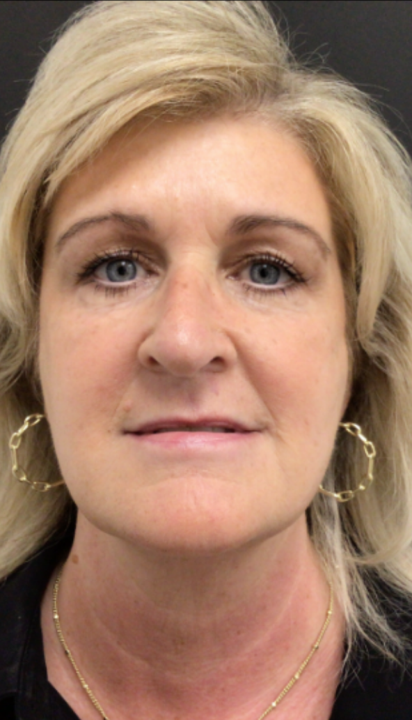 Botox® / Dysport® Case 44 After Image