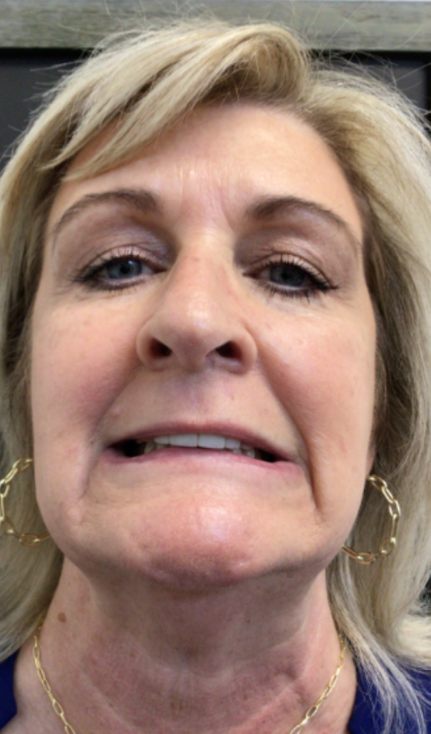 Botox® / Dysport® Case 44 Before Image