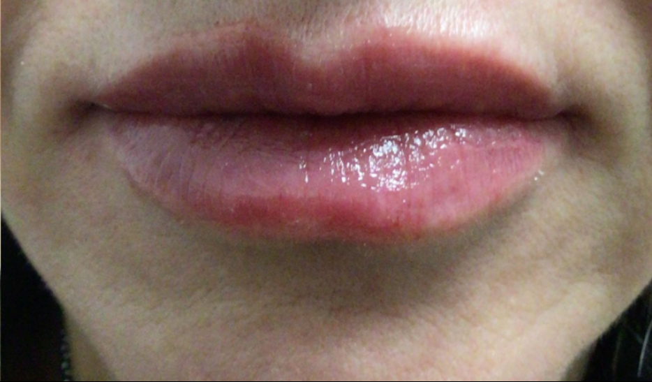 Lip Injections Case 39 After Image