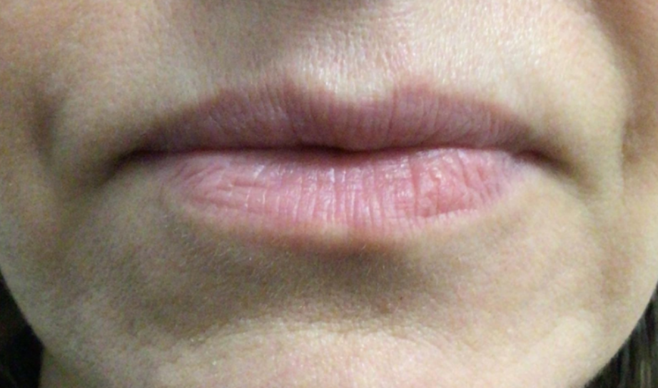 Lip Injections Case 39 Before Image