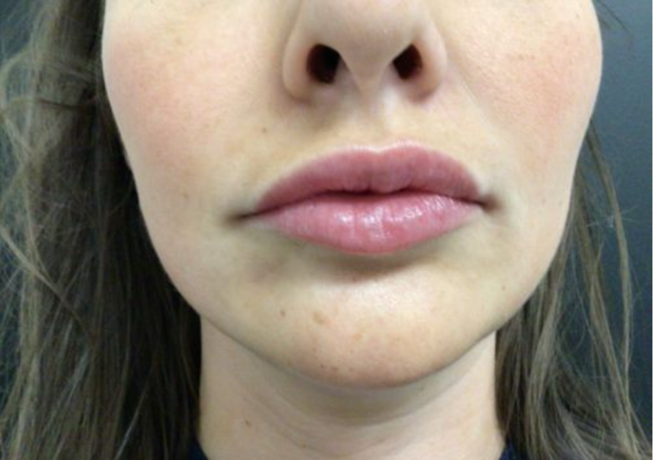 Lip Injections Case 40 After Image