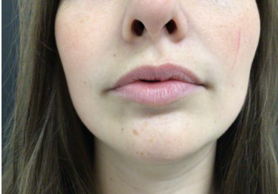 Lip Injections Case 40 Before Image